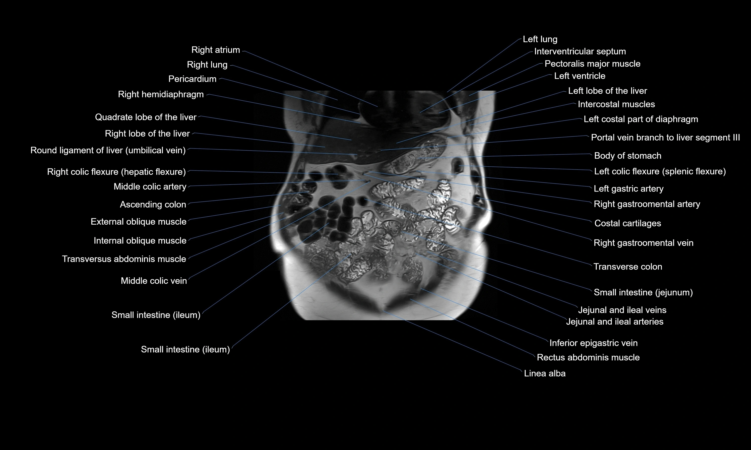 MRI Abdomen axial cross sectional anatomy radiology  image-img-00001-00016.webp